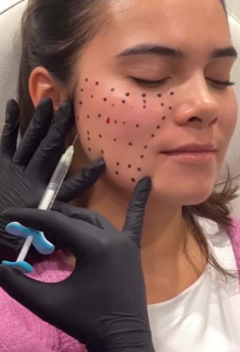 Dermal filler injection points mapped on the cheek before treatment at Accelerated Aesthetics in Elmhurst, IL