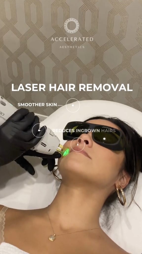 laser hair removal at Accelerated Aesthetics in Elmhurst IL