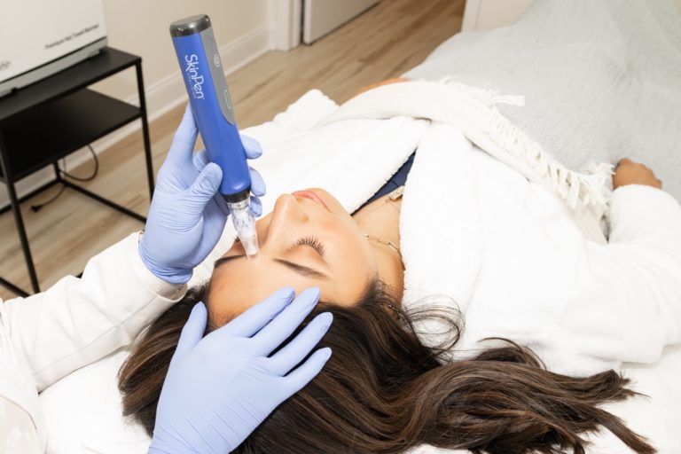 Microneedling facial treatment at Accelerated Aesthetics in Elmhurst, IL