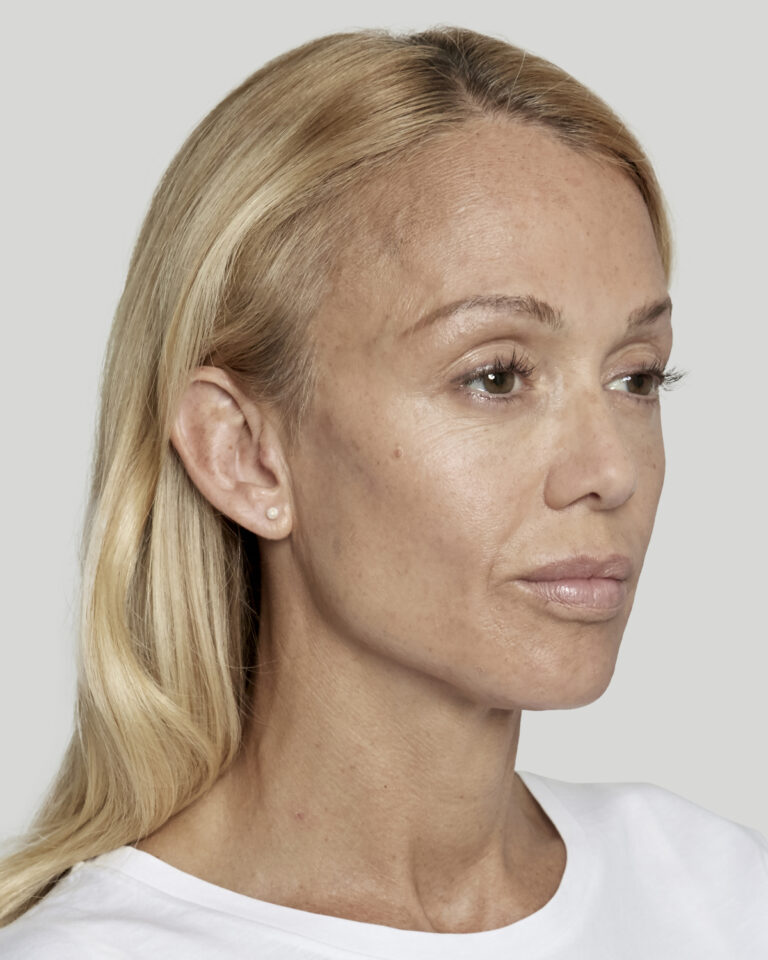 After Sculptra: restored volume in the temples and cheeks with a fuller, rested look