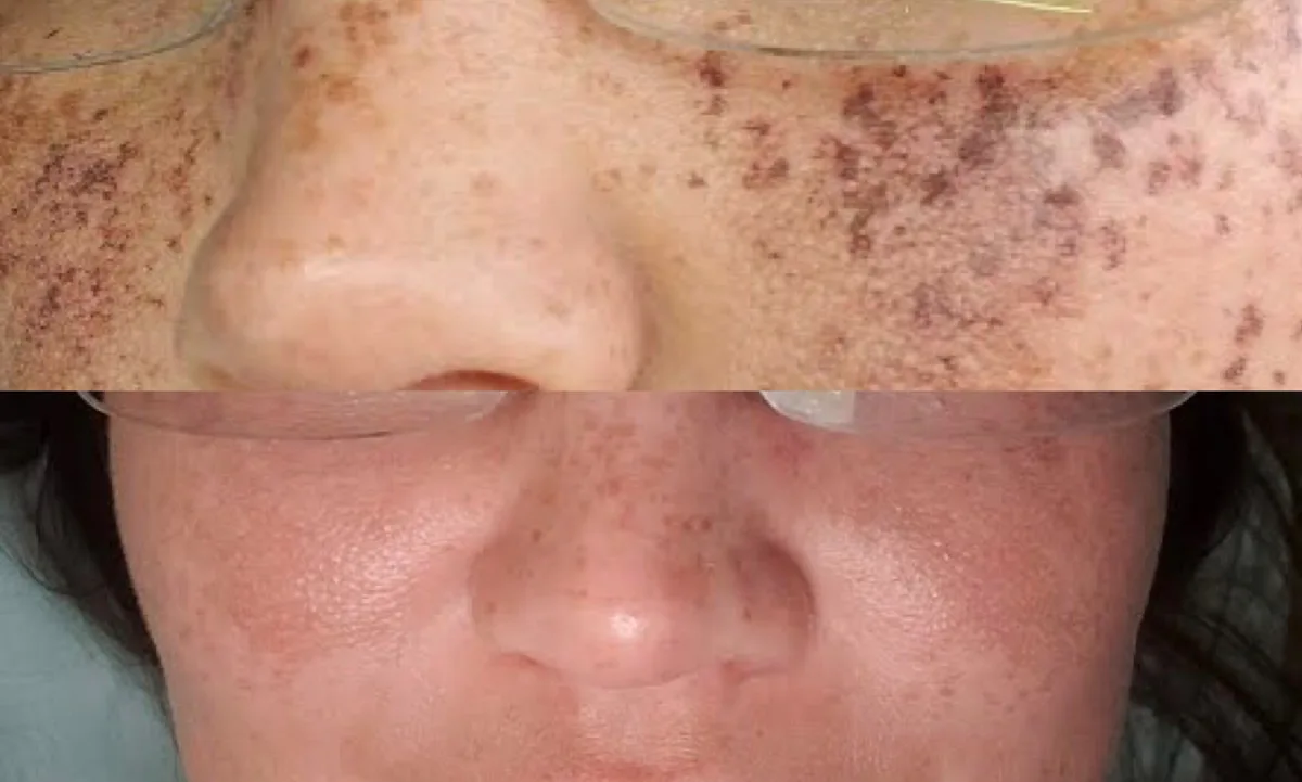 Before and after IPL photofacial for sun damage and dark spots on the cheeks and nose at Accelerated Aesthetics medspa in Elmhurst, IL